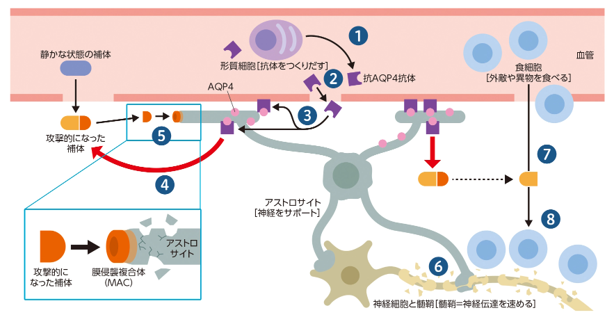 NMOSDの発症メカニズム