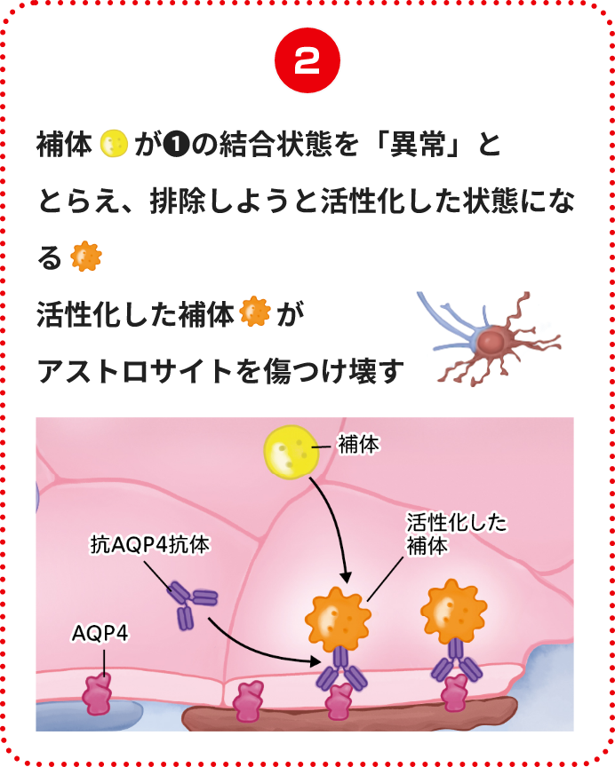 補体が❶の結合状態を「異常」ととらえ、排除しようと活性化した状態になる活性化した補体がアストロサイトを傷つけ壊す