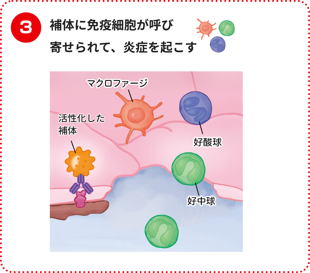補体に免疫細胞が呼び寄せられて、炎症を起こす