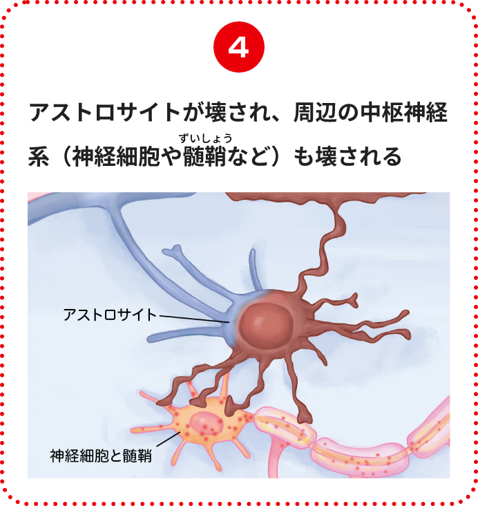 アストロサイトが壊され、周辺の中枢神経系（神経細胞や髄鞘など）も壊される