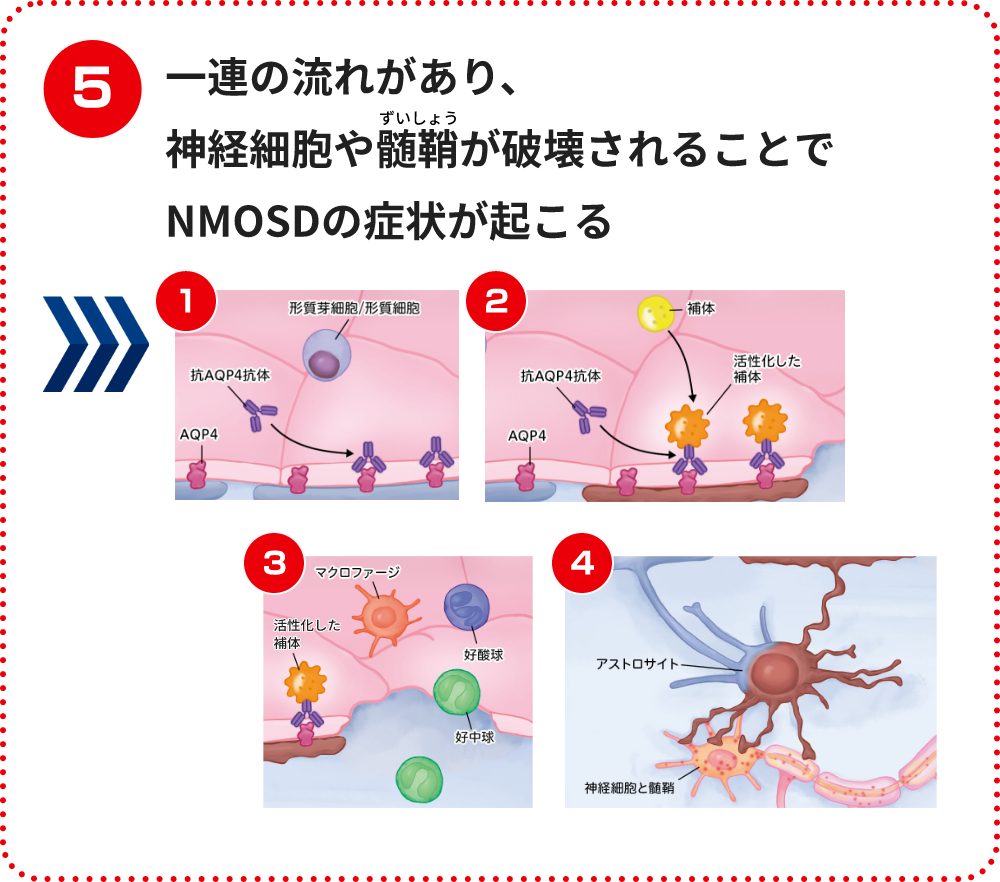 一連の流れがあり、神経細胞や髄鞘が破壊されることでNMOSDの症状が起こる