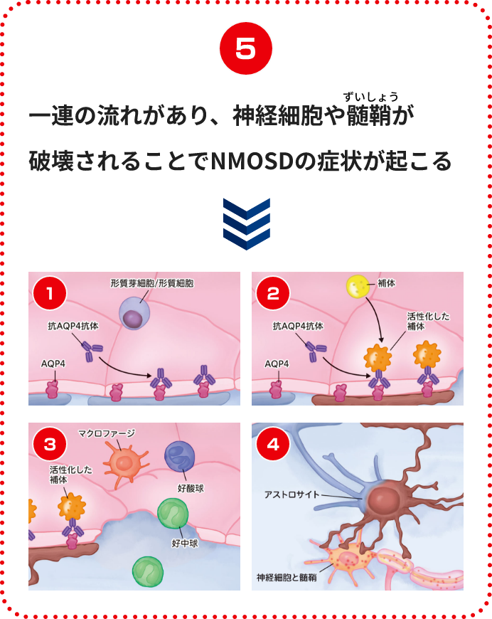 一連の流れがあり、神経細胞や髄鞘が破壊されることでNMOSDの症状が起こる